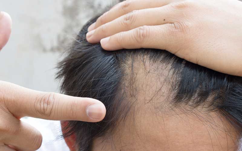 Tratamiento cabello alopecia